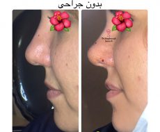 کوچک سازی بینی بدون جراحی